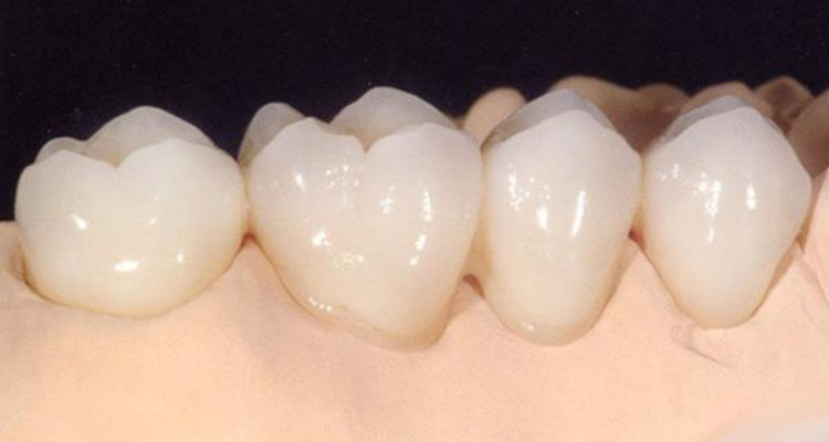 Ceramic Crowns
