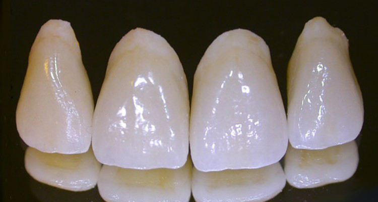 Porcelain Dental Crowns