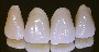 Porcelain Dental Crowns